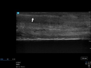 Ultrasound scan fibrosis peyronies