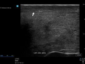 Ultrasound scan fibrosis peyronies